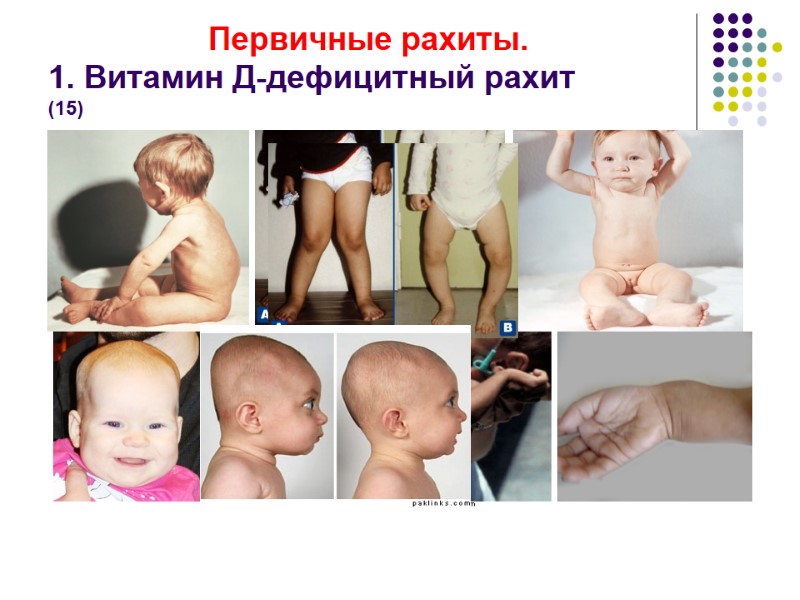 Первичные рахиты. 1. Витамин Д-дефицитный рахит        